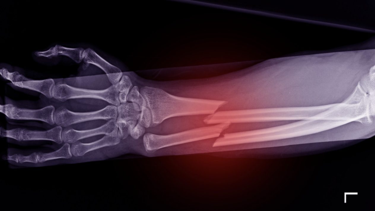 An image of a fractured bone